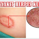 Illustration for article titled Obat Herpes Alami